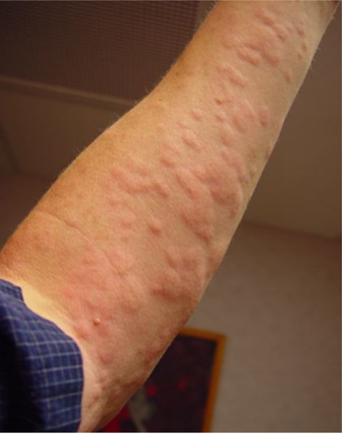 الشرى أو الأرتيكاريا